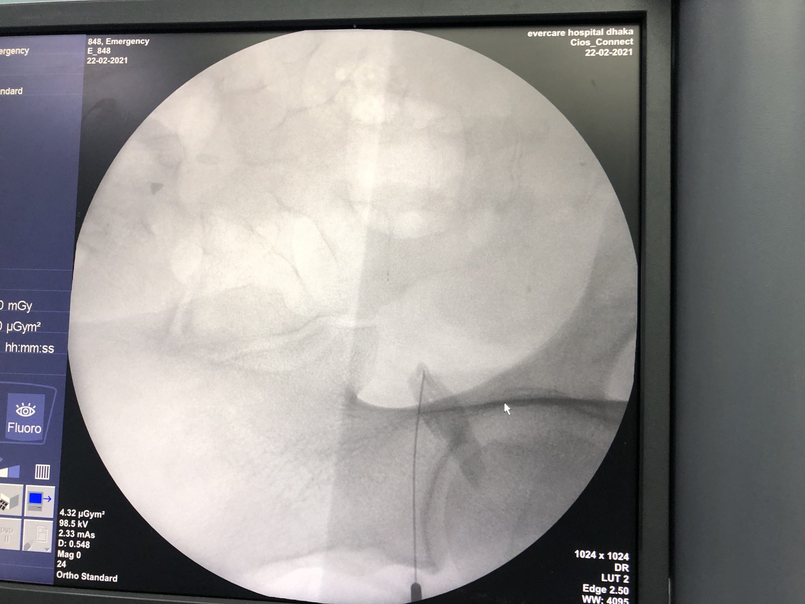 Piriformis block